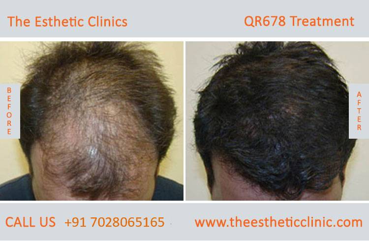 qr678 treatment, qr678 hair injection injection before after photos in mumbai india (1)